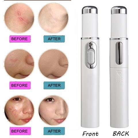 Blue Light Therapy Acne Laser Pen Soft Scar Wrinkle Removal Treatment Device Skin Care Beauty Equipment - الصورة 3