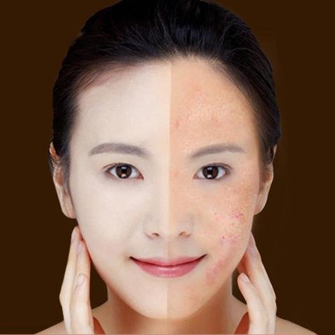Blue Light Therapy Acne Laser Pen Soft Scar Wrinkle Removal Treatment Device Skin Care Beauty Equipment - الصورة 8